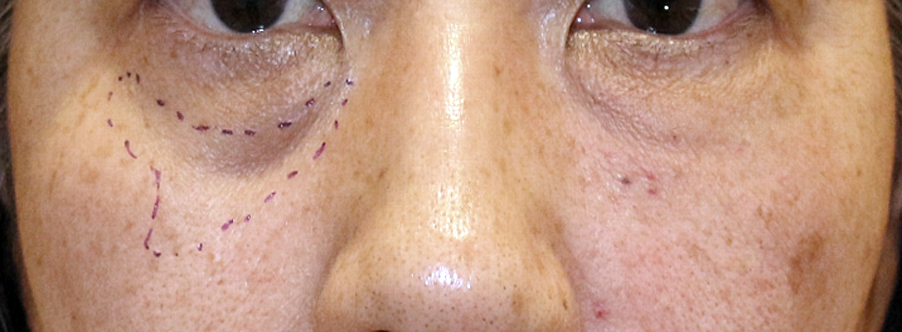 【60代女性・目の下のクマを注入治療だけで】プレミアムPRP皮膚再生療法（7ヶ月後） Before 