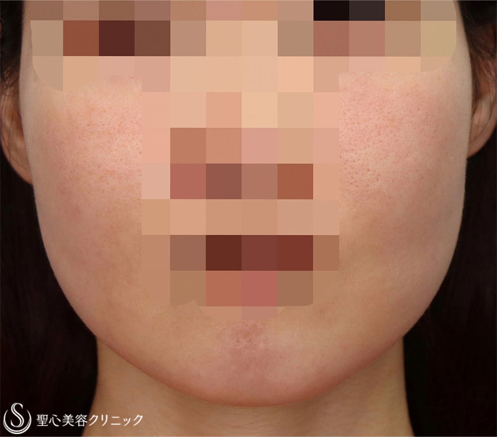 【30代女性・フェイスラインをナチュラルにスッキリ！！】フェイスリフト＋脂肪吸引（頬）（術後1ヶ月） Before 