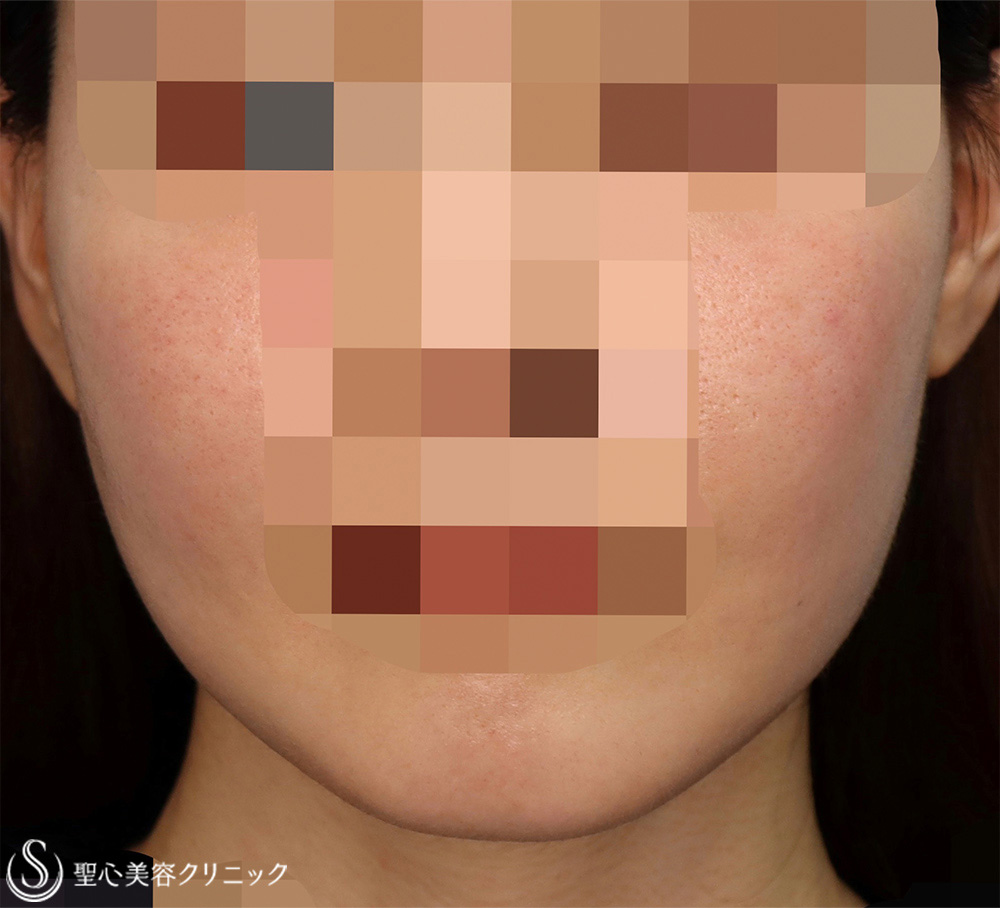 【30代女性・フェイスラインをナチュラルにスッキリ！！】フェイスリフト＋脂肪吸引（頬）（術後1ヶ月） After 