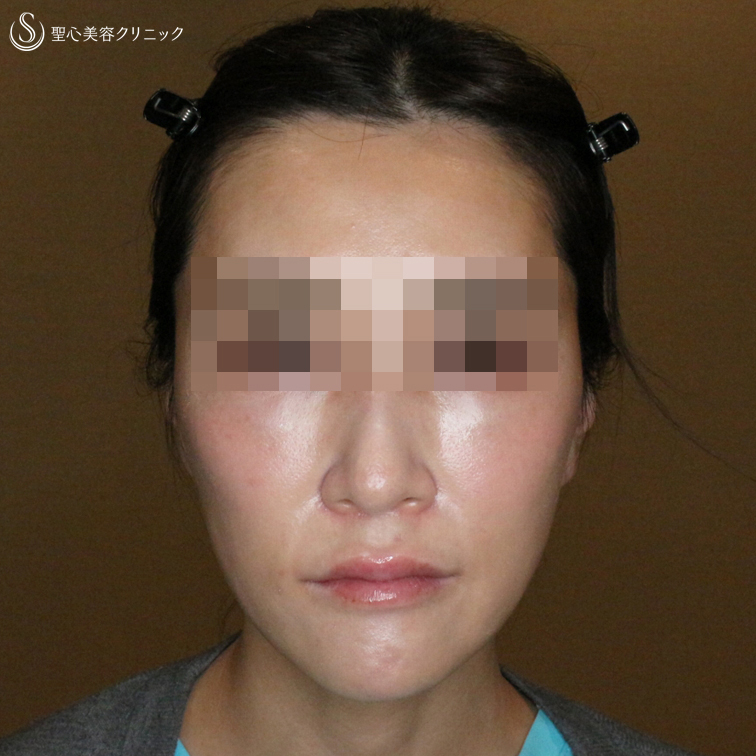 【30代女性・スタッフ処置の経過】プレミアムPRP皮膚再生療法＆ドクターハイフ（1ヶ月後） After 
