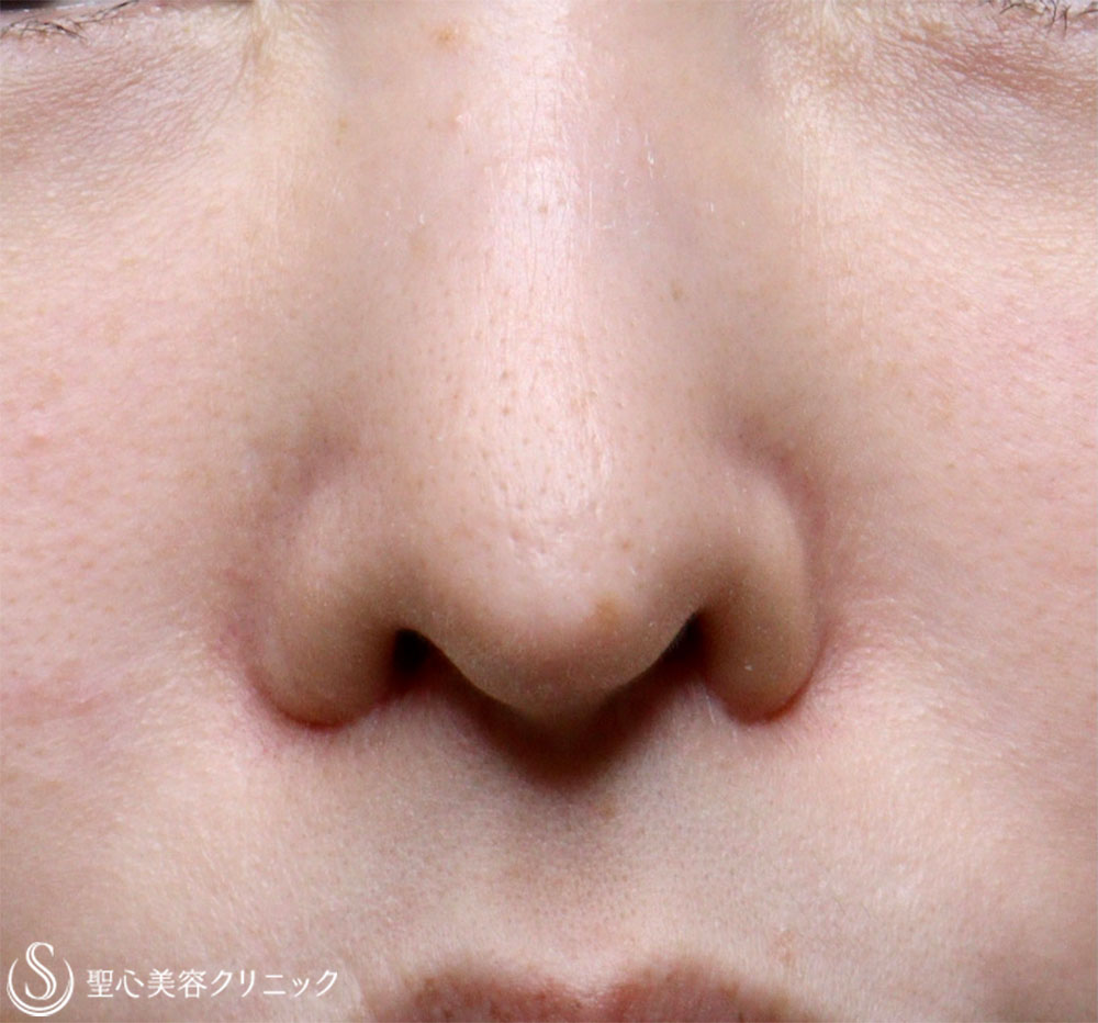 【20代女性・鼻の穴が見えるのが気になる】鼻孔縁下降術 Before 