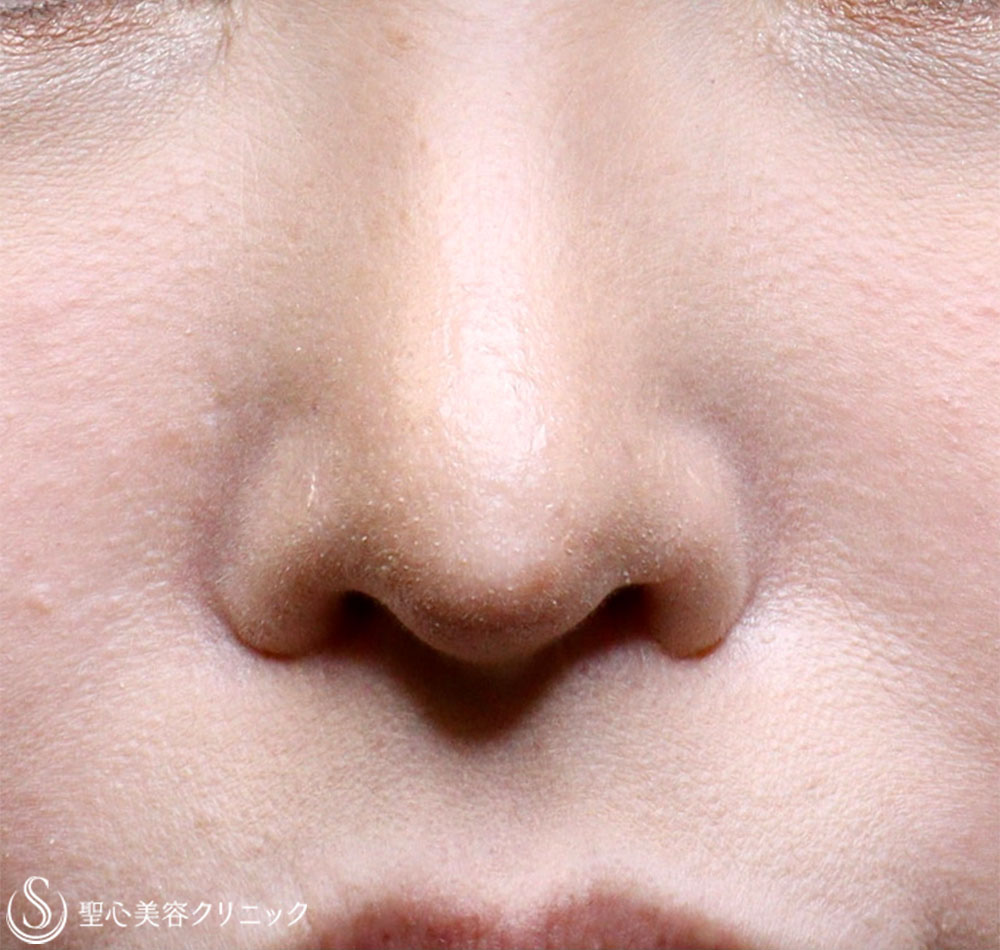【20代女性・鼻の穴が見えるのが気になる】鼻孔縁下降術 After 