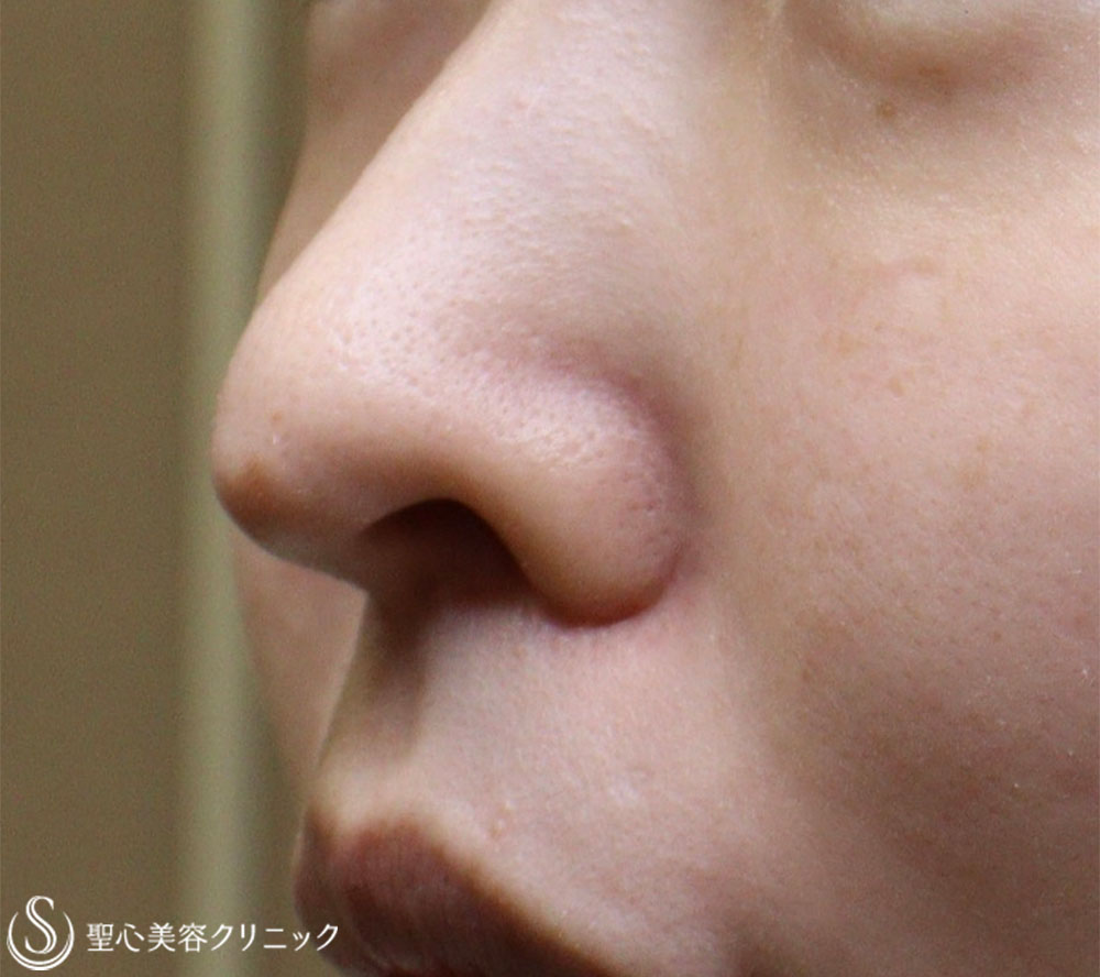 【20代女性・鼻の穴が見えるのが気になる】鼻孔縁下降術 Before 