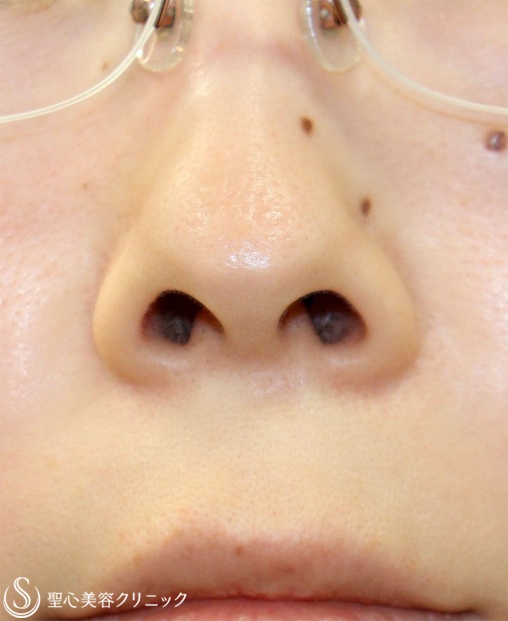 【20代女性・鼻の穴が見えるのが気になる】鼻孔縁下降術（術後1週間） Before 