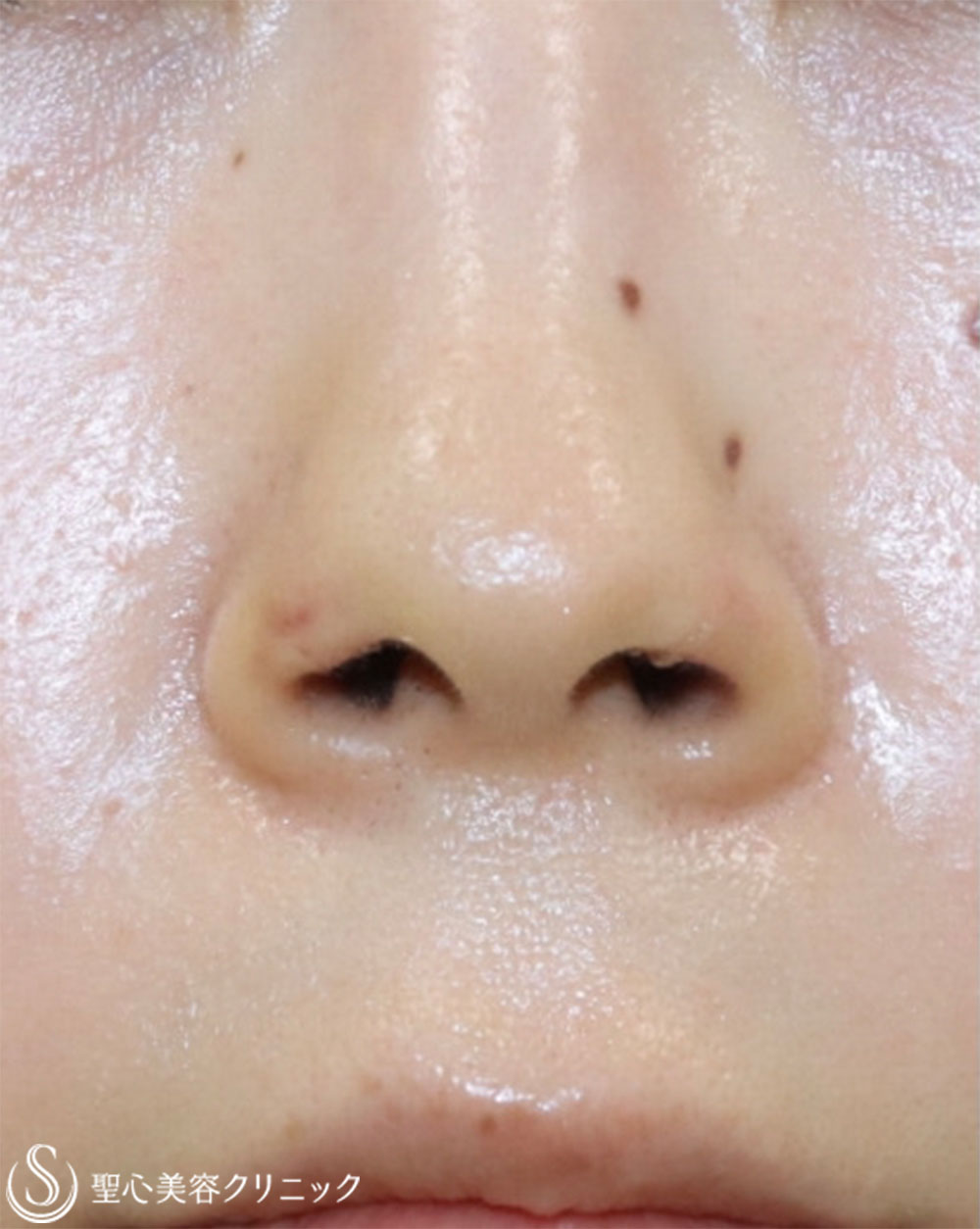 【20代女性・鼻の穴が見えるのが気になる】鼻孔縁下降術（術後1週間） After 