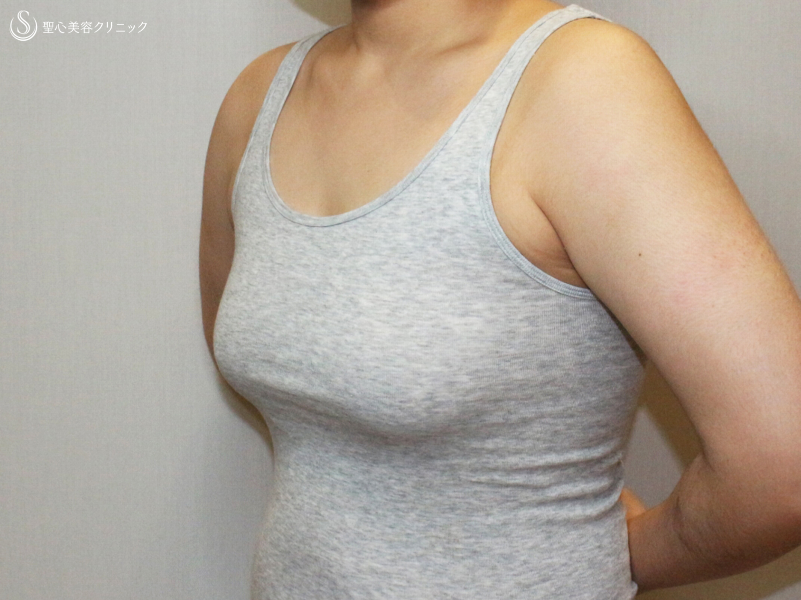 【20代女性・大きなバストを男らしい胸に】乳腺切除術+脂肪吸引（1ヶ月後） Before 