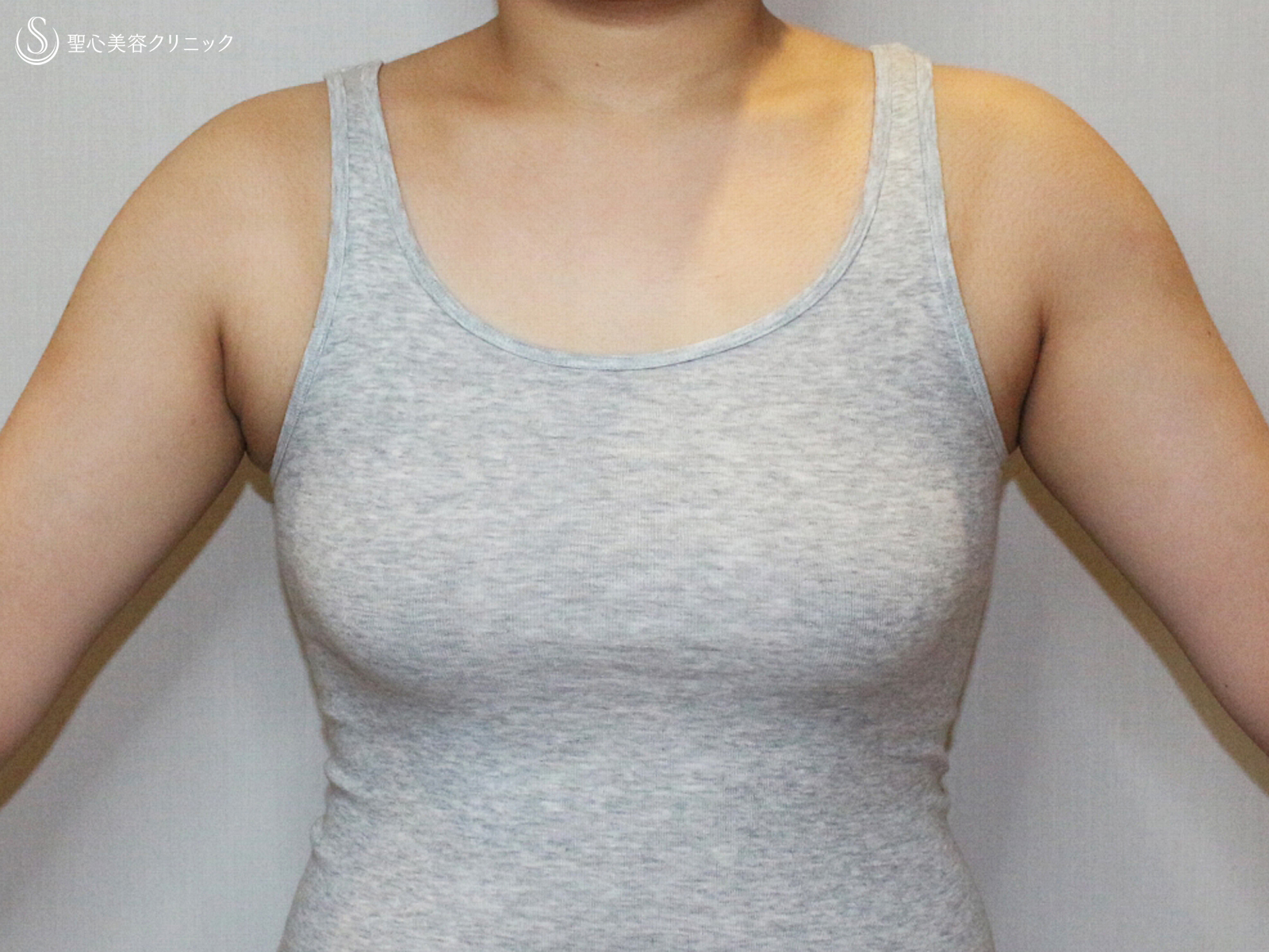【20代女性・大きなバストを男らしい胸に】乳腺切除術+脂肪吸引（1ヶ月後） Before 