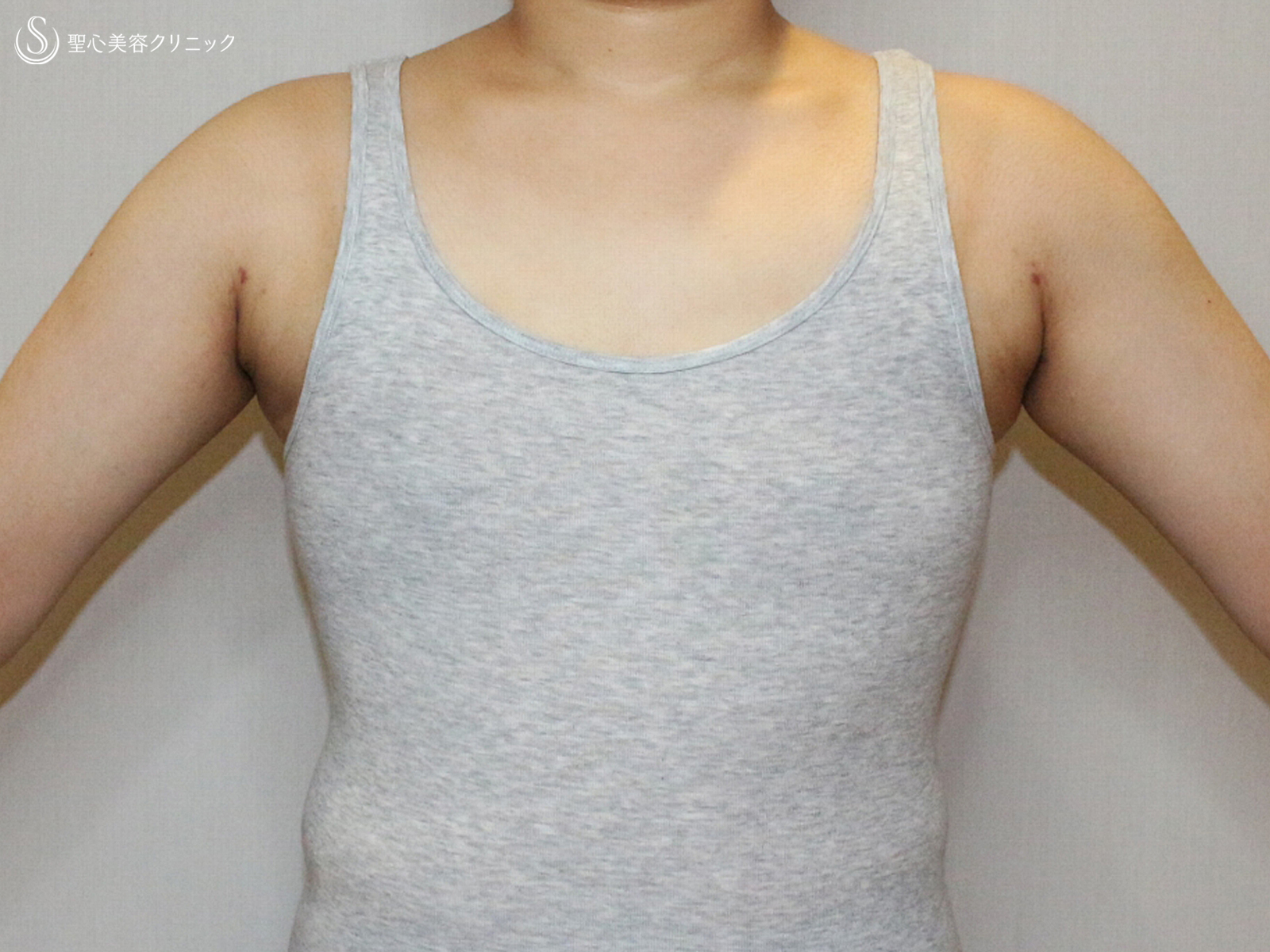 【20代女性・大きなバストを男らしい胸に】乳腺切除術+脂肪吸引（1ヶ月後） After 