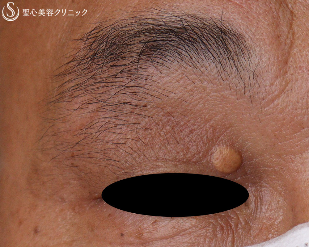 【50代男性・眼瞼黄色腫】電気凝固法（1か月後） Before 
