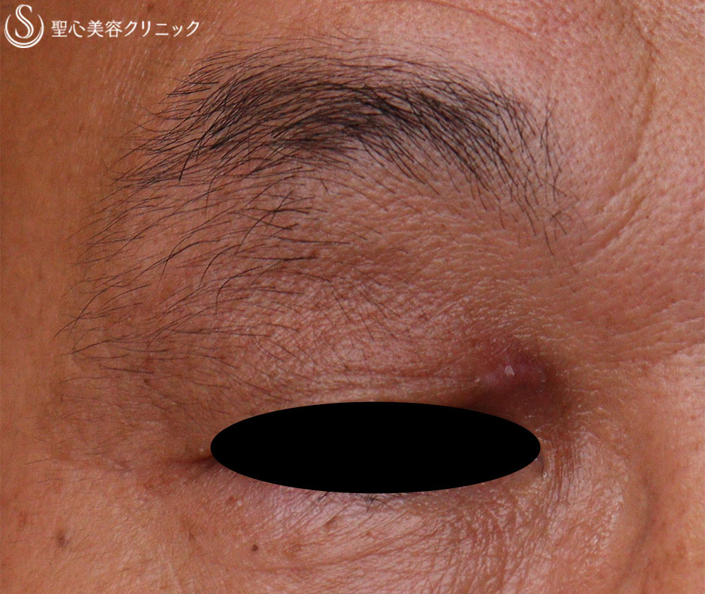 【50代男性・眼瞼黄色腫】電気凝固法（1か月後） After 