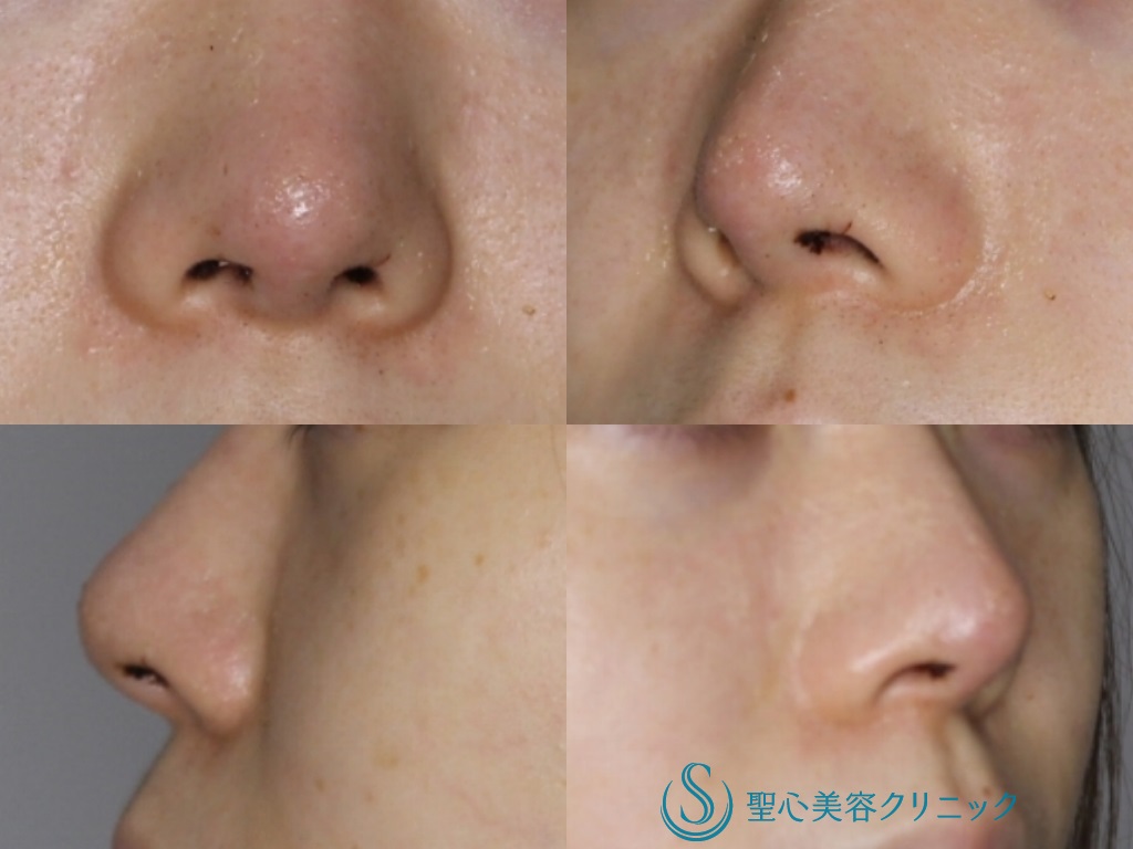 【20代女性・細く形の良い鼻先に】鼻尖縮小+鼻尖形成（３DPCLドーム）（1か月後） After 