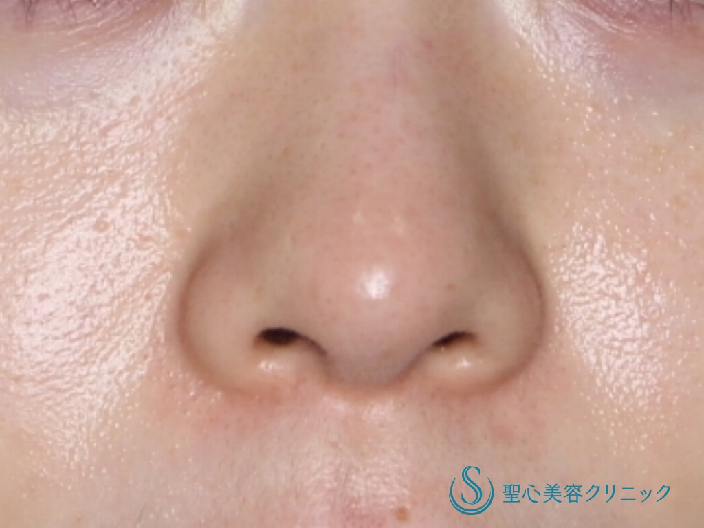 【20代女性・細く形の良い鼻先に】鼻尖縮小+鼻尖形成（３DPCLドーム）（1か月後） After 