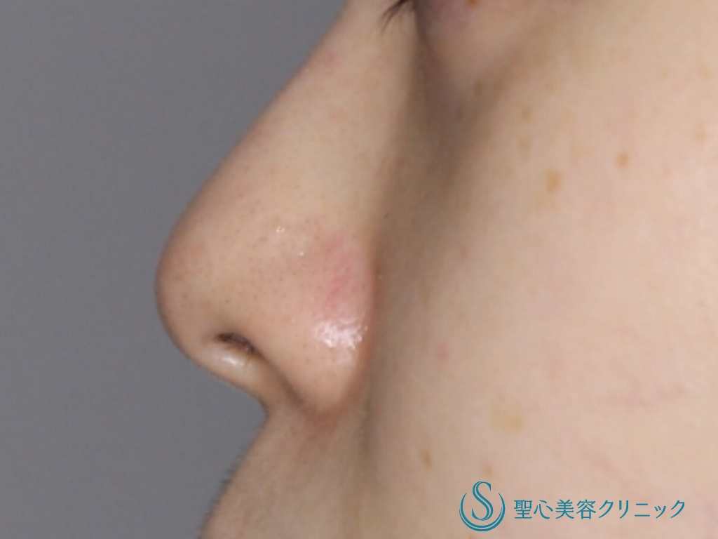 【20代女性・細く形の良い鼻先に】鼻尖縮小+鼻尖形成（３DPCLドーム）（1か月後） Before 