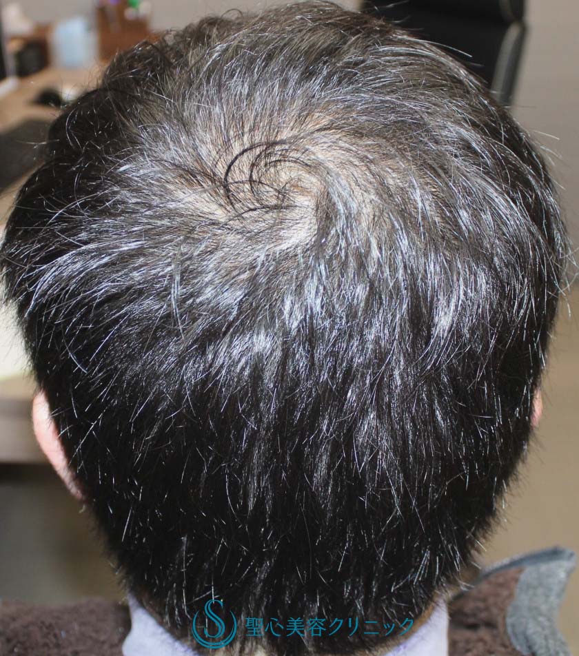 【30代男性・AGA（男性型脱毛症）】ケラステム手術と内服との複合治療（12か月後） Before 