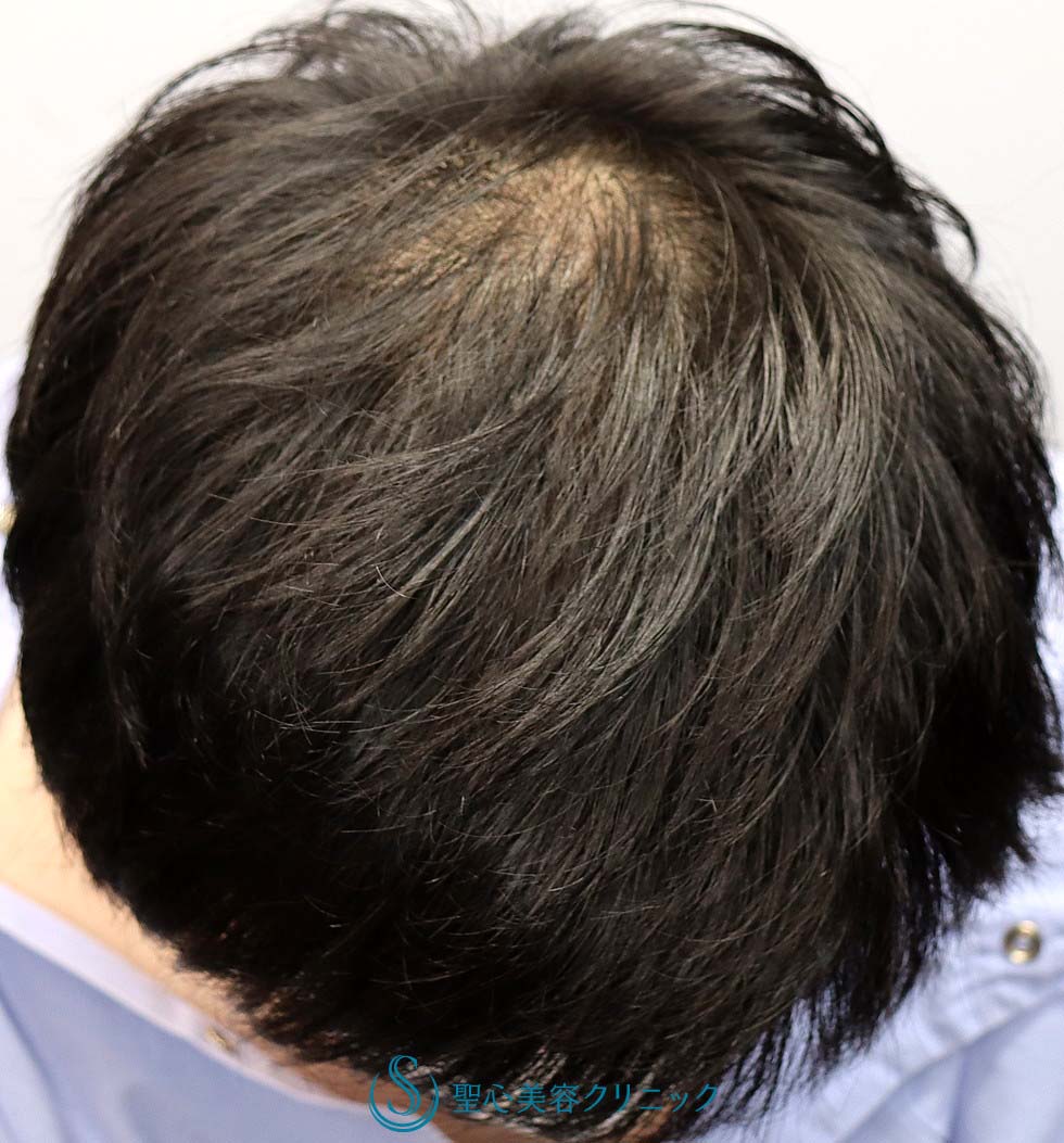 【30代男性・AGA（男性型脱毛症）】ケラステム手術と内服との複合治療（12か月後） After 