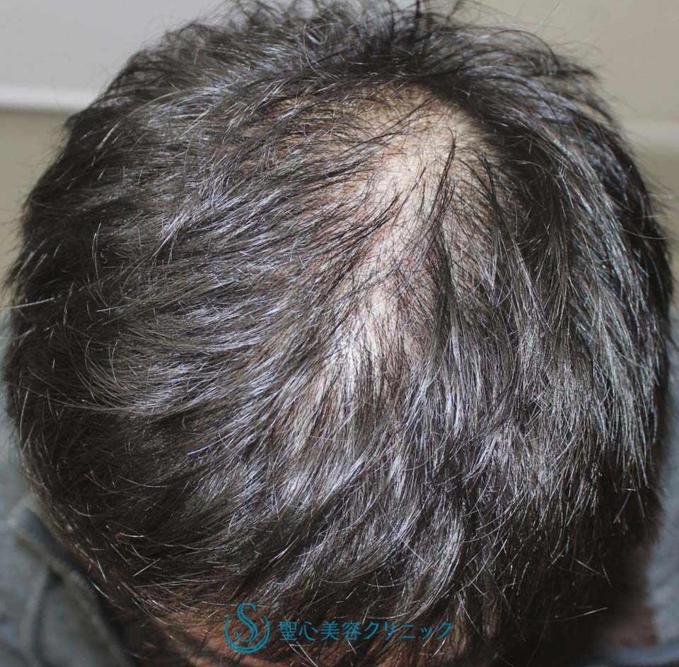【30代男性・AGA（男性型脱毛症）】ケラステム手術と内服との複合治療（12か月後） Before 