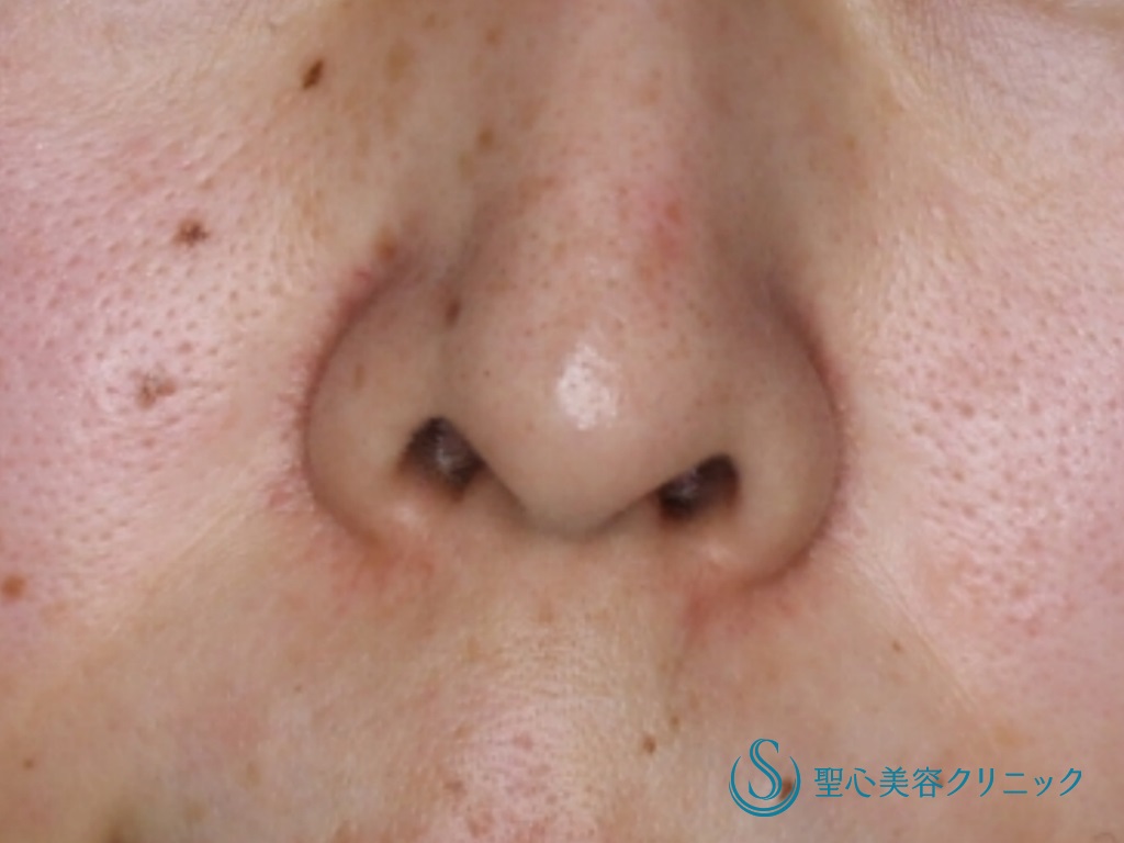 【40代女性・鼻の穴を目立たなくしたい】鼻孔縁下降術（1か月後） Before 