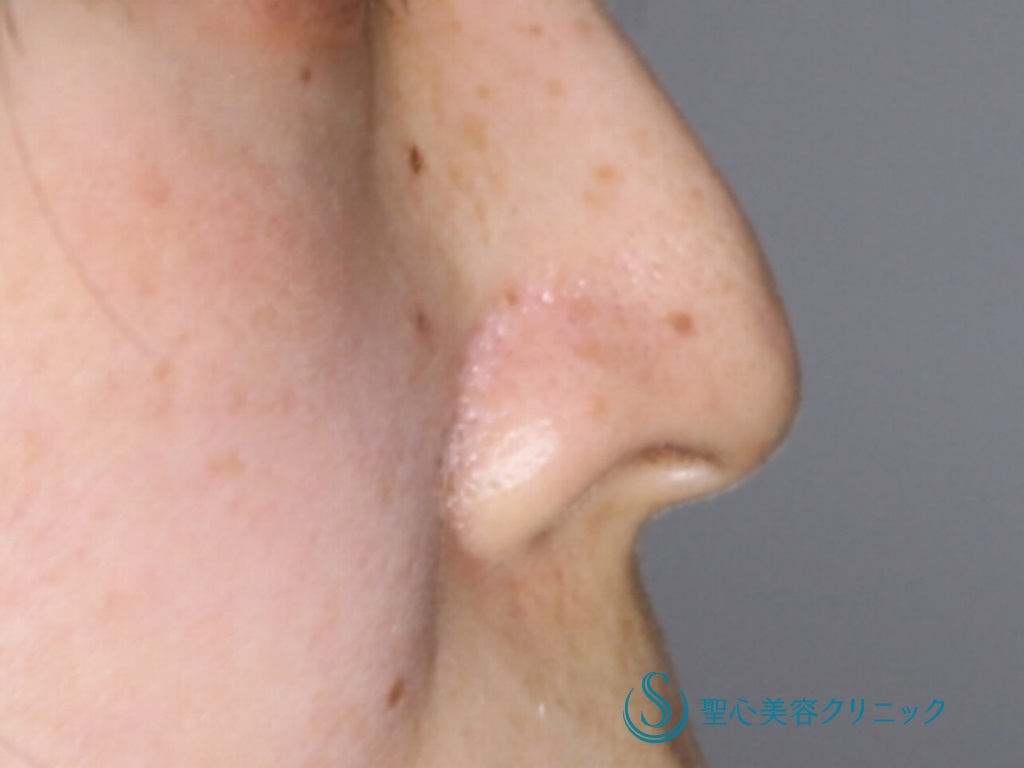 【40代女性・鼻の穴を目立たなくしたい】鼻孔縁下降術（1か月後） After 