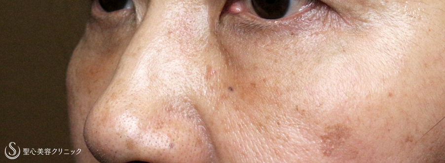 【60代女性・目の下のクマを注入治療だけで】プレミアムPRP皮膚再生療法（7ヶ月後） After 