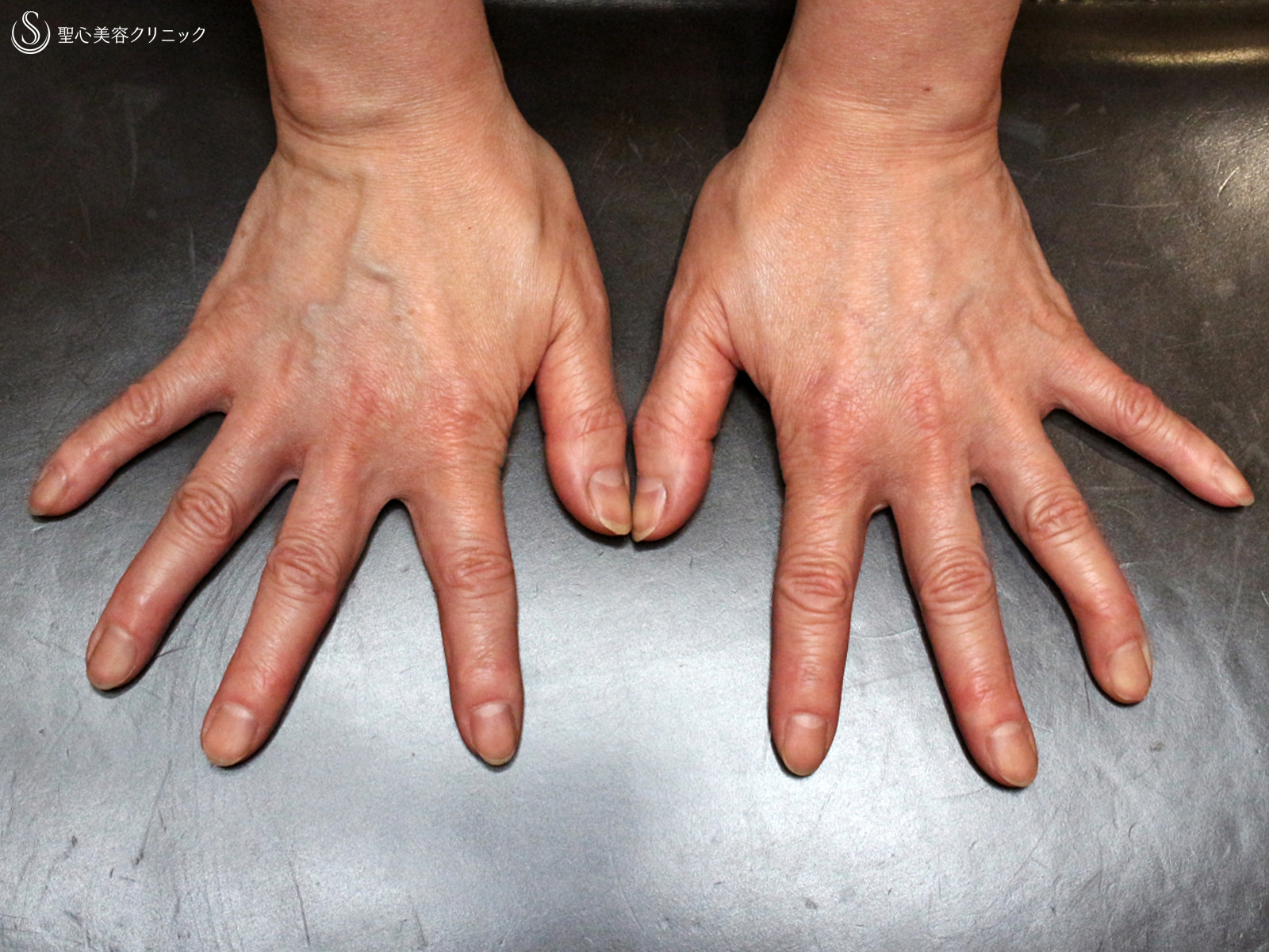 【40代女性・手の甲は年齢を隠せない】プレミアムPRP皮膚再生療法（3年3ヶ月後） After 