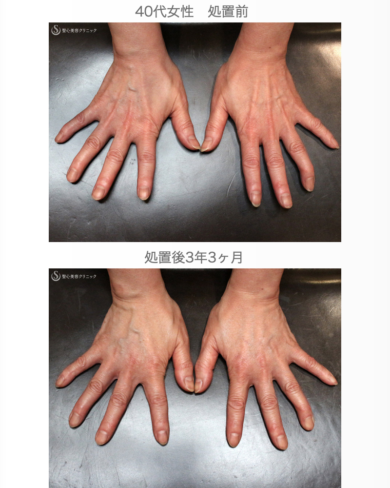 【40代女性・手の甲は年齢を隠せない】プレミアムPRP皮膚再生療法（3年3ヶ月後） After 