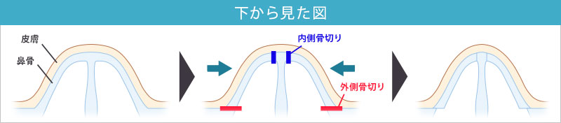 鼻骨骨切り_下から見た図