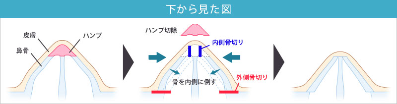 鼻骨骨切り＋ハンプ切除_下から見た図