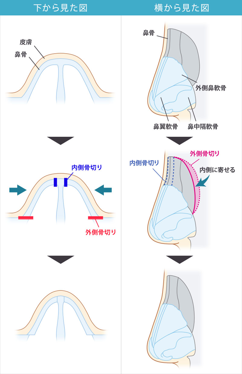 鼻骨骨切り