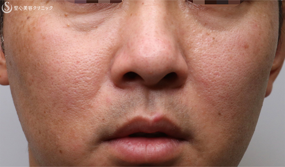 【30代男性・目の下の切らないクマ治療！！】プレミアムPRP皮膚再生療法（6ヶ月後） Before 