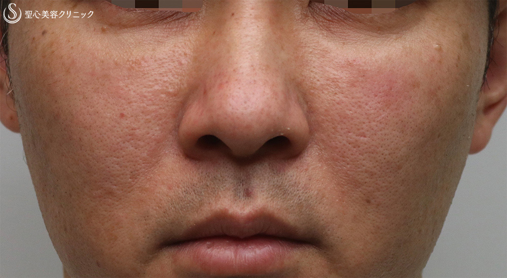 【30代男性・目の下の切らないクマ治療！！】プレミアムPRP皮膚再生療法（6ヶ月後） After 