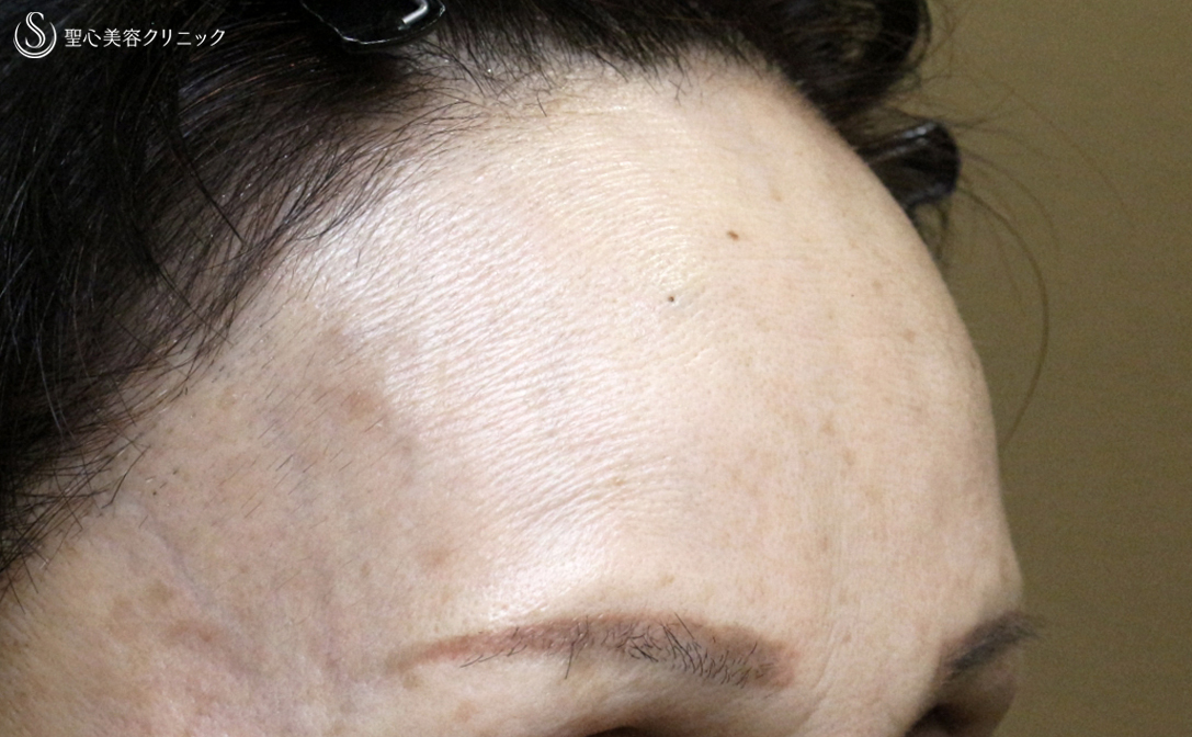 【50代女性・注入でオデコの若返り 】プレミアムPRP皮膚再生療法（7年後） After 