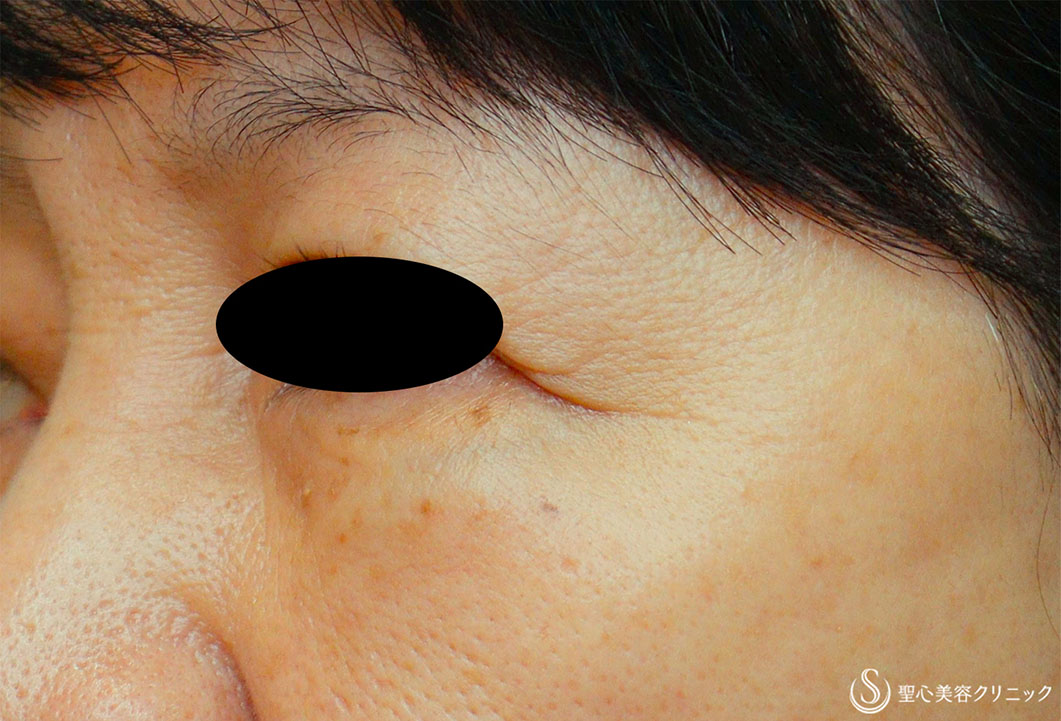 【60代女性・目の下のたるみ】経結膜下脱脂、プレミアムPRP皮膚再生療法（2年後） After 
