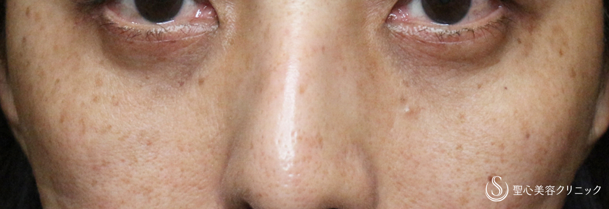 【50代女性・目の下のくま＆タルミ】ハムラ法+α＆プレミアムPRP皮膚再生療法（3年後） After 