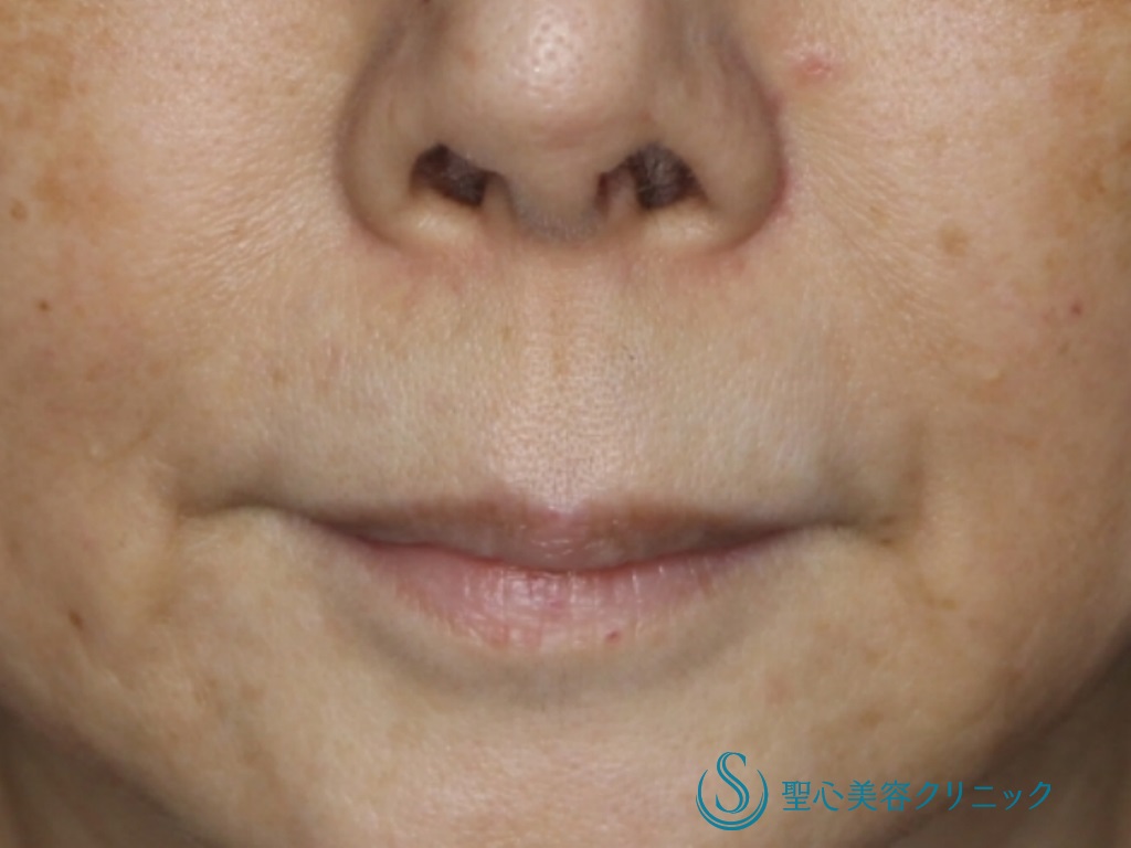 【60代女性・鼻下を短く、唇の形を自然に】リップリフト（1ヵ月、3ヶ月後） Before 