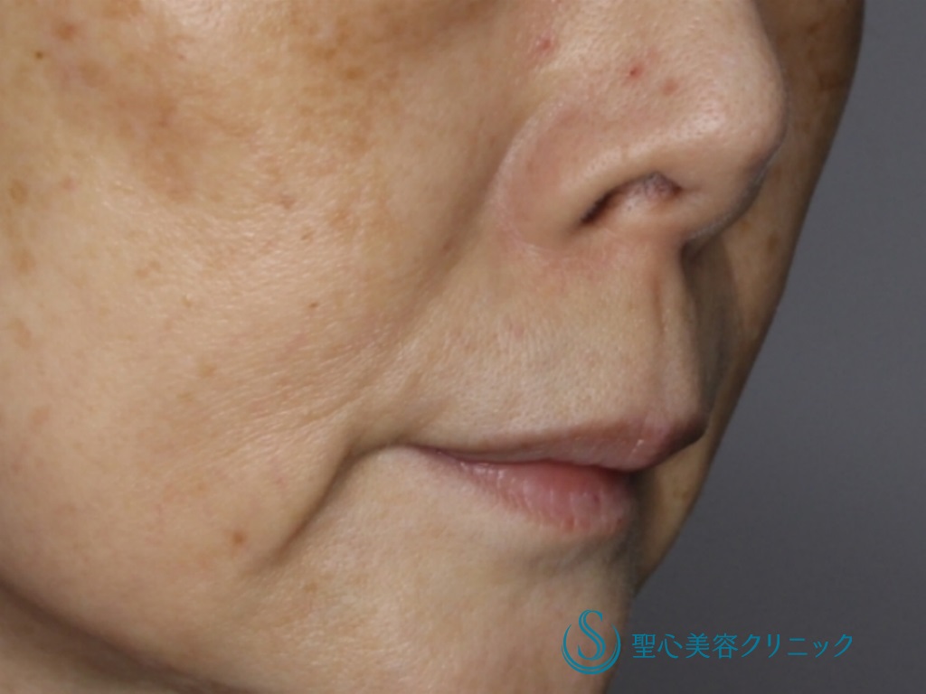 【60代女性・鼻下を短く、唇の形を自然に】リップリフト（1ヵ月、3ヶ月後） Before 
