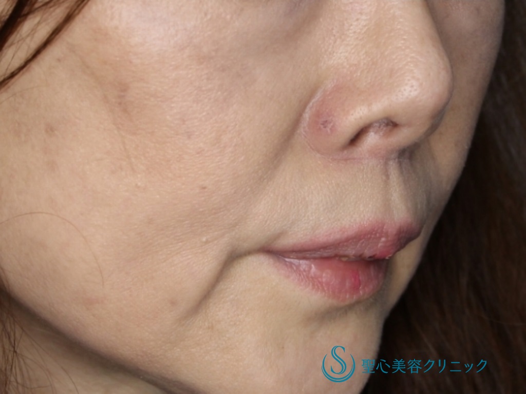 【60代女性・鼻下を短く、唇の形を自然に】リップリフト（1ヵ月、3ヶ月後） After 