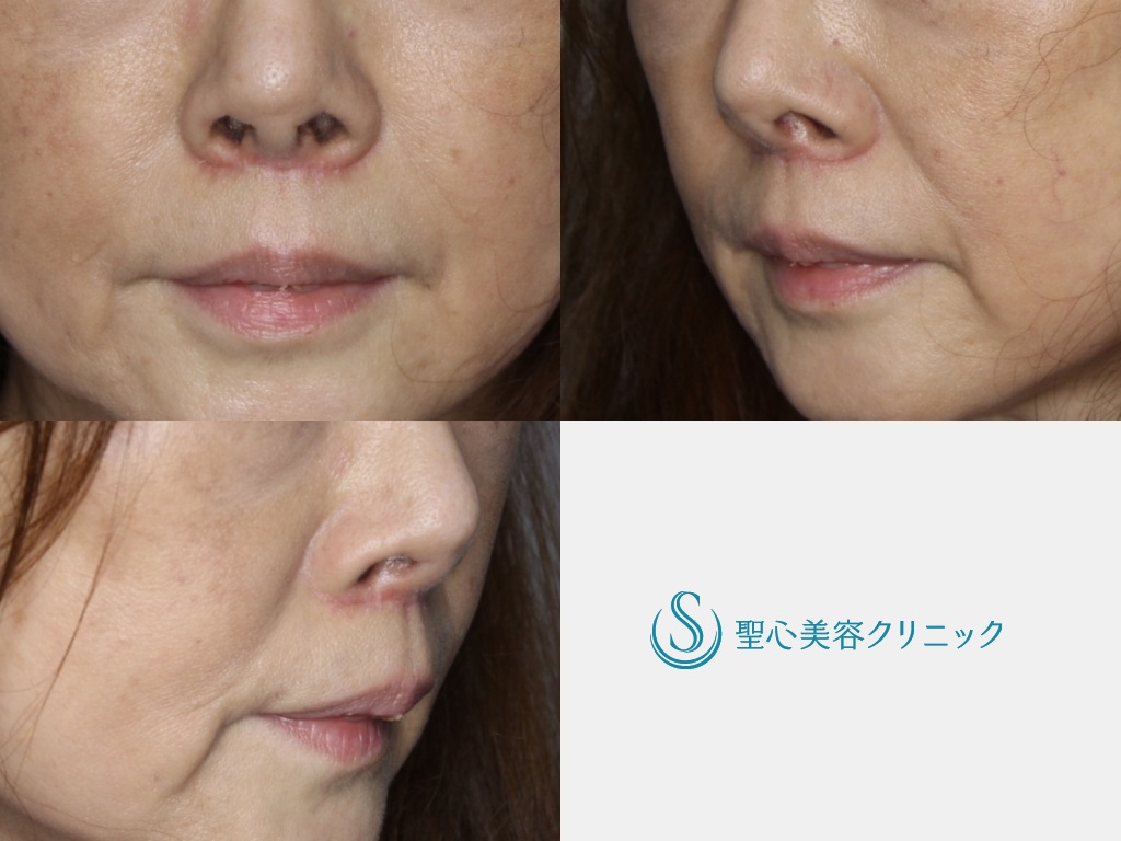 【60代女性・鼻下を短く、唇の形を自然に】リップリフト（1ヵ月、3ヶ月後） After 