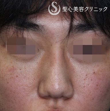 【30代男性・鼻根を高く】プロテーゼによる隆鼻術（1ヶ月後） After 