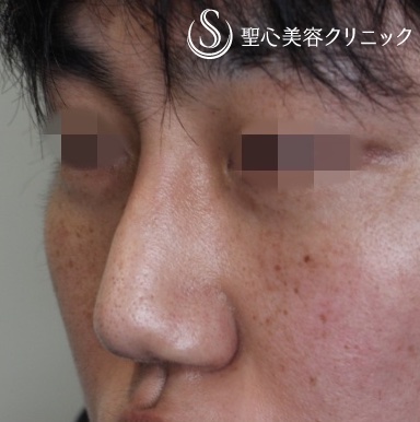 【30代男性・鼻根を高く】プロテーゼによる隆鼻術（1ヶ月後） After 