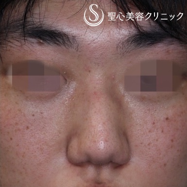 【30代男性・鼻根を高く】プロテーゼによる隆鼻術（1ヶ月後） Before 