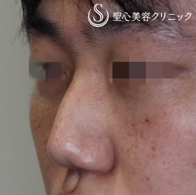 【30代男性・鼻根を高く】プロテーゼによる隆鼻術（1ヶ月後） Before 