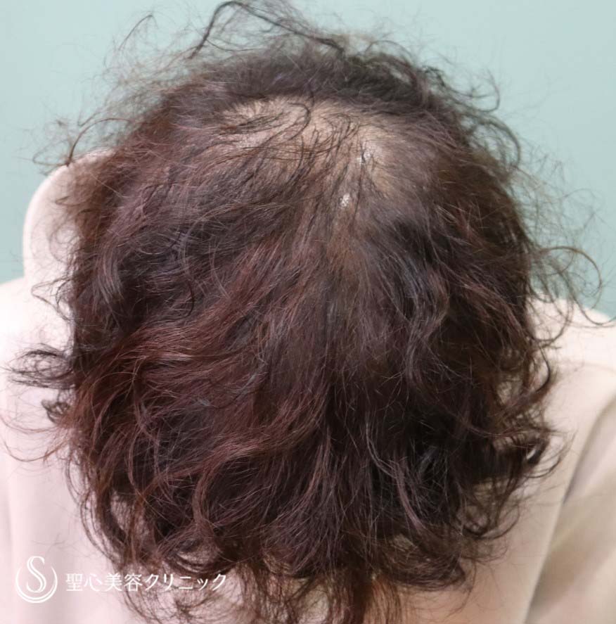 【30代女性・薄毛】パントガール、ヴェラルティス（1年3か月後） Before 