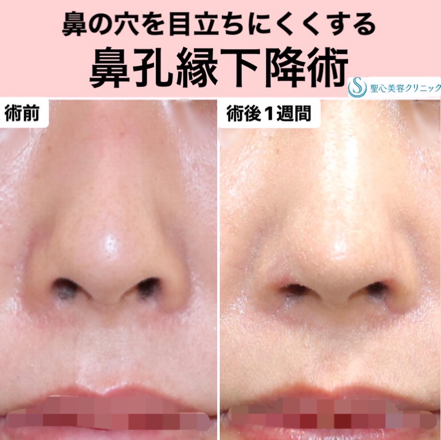 【20代女性・鼻の穴を目立ちにくくする】鼻孔縁下降術（1週間後） After 