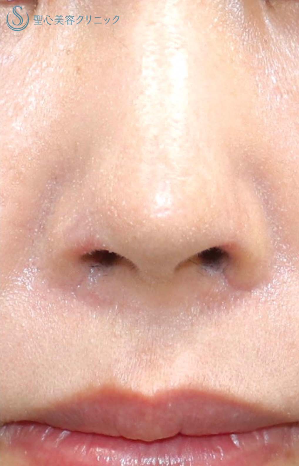 【20代女性・鼻の穴を目立ちにくくする】鼻孔縁下降術（1週間後） After 