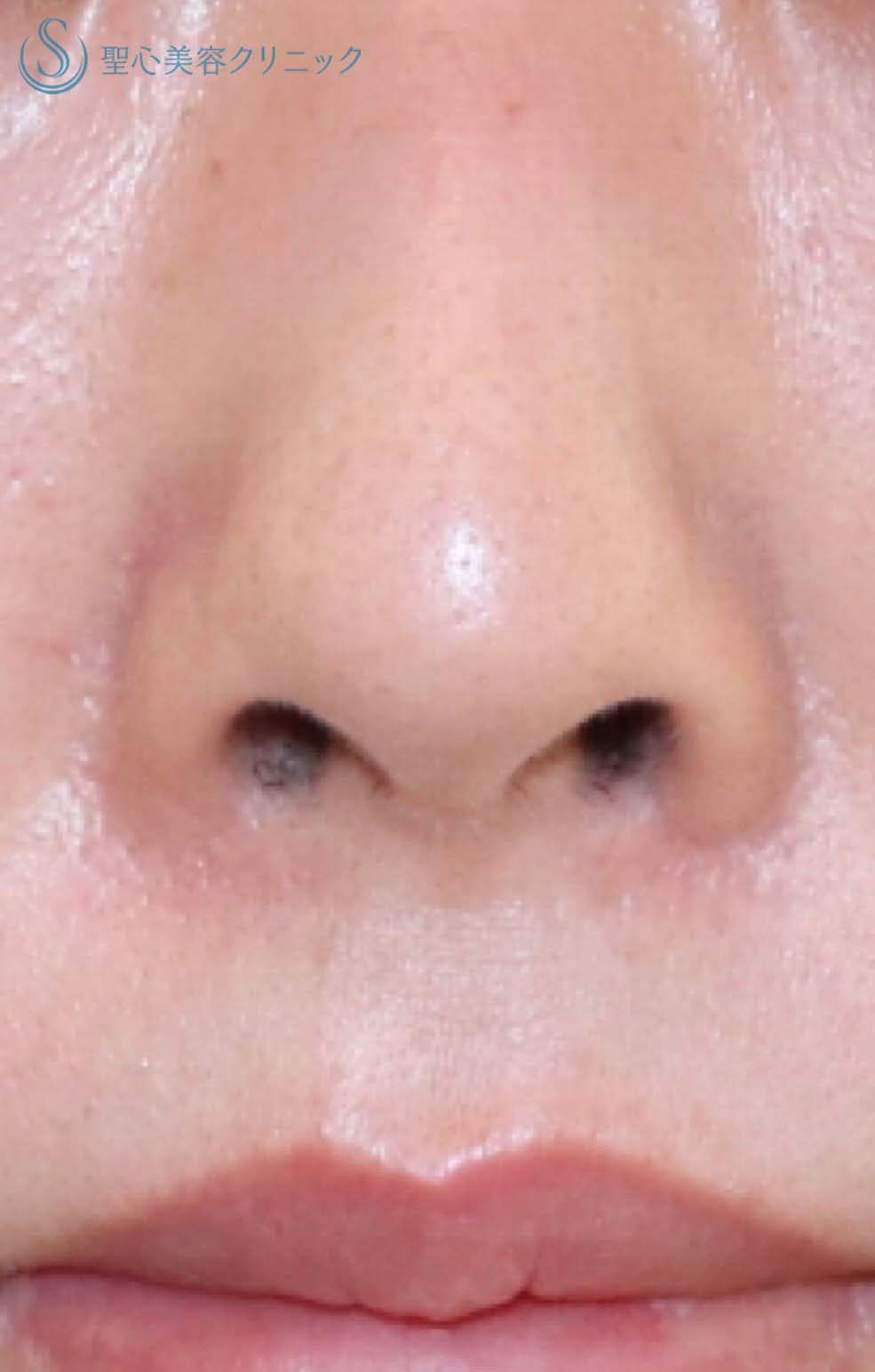 【20代女性・鼻の穴を目立ちにくくする】鼻孔縁下降術（1週間後） Before 