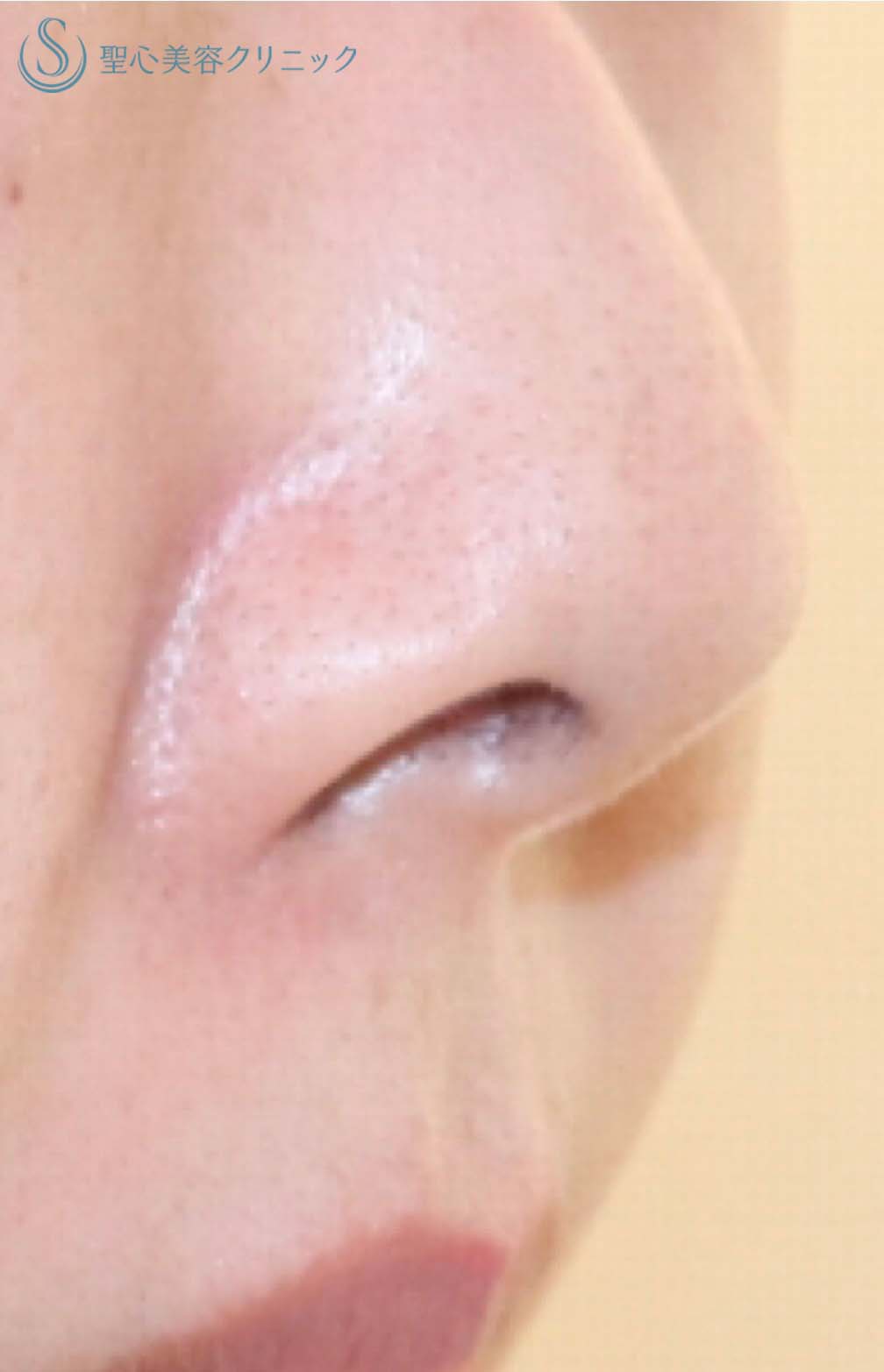 【20代女性・鼻の穴を目立ちにくくする】鼻孔縁下降術（1週間後） Before 