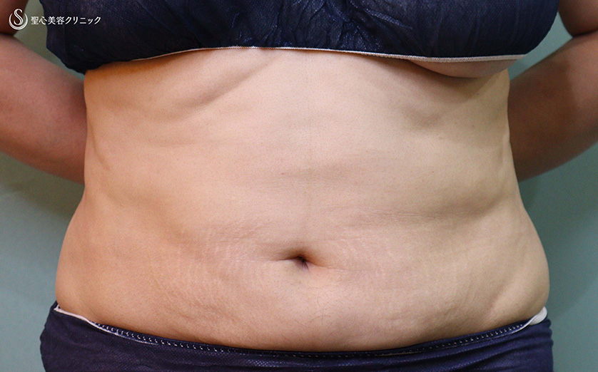 【40代女性・腹部のボリューム・凹凸】ベイザーリポ2.2脂肪吸引（2か月後） Before 