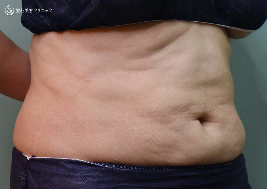 【40代女性・腹部のボリューム・凹凸】ベイザーリポ2.2脂肪吸引（2か月後） Before 