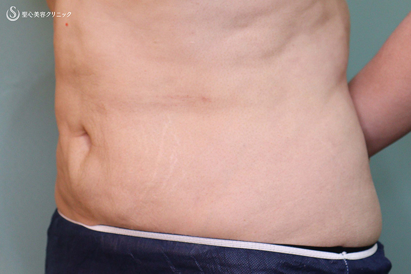 【40代女性・腹部のボリューム・凹凸】ベイザーリポ2.2脂肪吸引（2か月後） After 