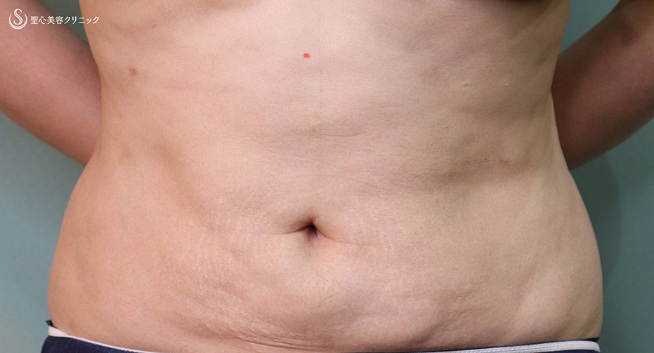 【40代女性・腹部のボリューム・凹凸】ベイザーリポ2.2脂肪吸引（2か月後） After 